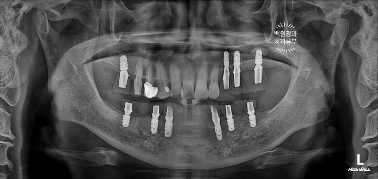 아래 어금니 임플란트 6개면 틀니를 안써도 됩니다.  치주염 전문 착한치과. 치료기간/임시치아과정/후기/비용. 관련 이미지 21