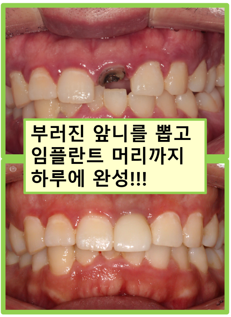 앞니 머리가 기둥째 부러졌어요. 발치 동시 뼈이식 오스템 BA 임플란트. 치료과정/치료기간/비용/후기. 압구정 치과. 관련 이미지 1