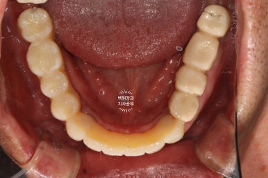 임플란트장인의 마음으로 8개월간 전체임플란트 완성. 치주과 전문의. 관련 이미지 24
