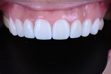 신사역 라미네이트. 결혼식 전 앞니 고민, 얇은 세라믹 레브네이트로 해결! 관련 이미지 24