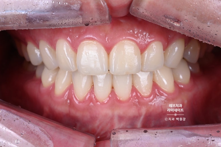 레브네이트 베이직. 치아미백과 치아교정을 한번에! 치아삭제 사진 있음. 신사역 치과 앞니라미네이트 모델/비용/후기. 관련 이미지 3
