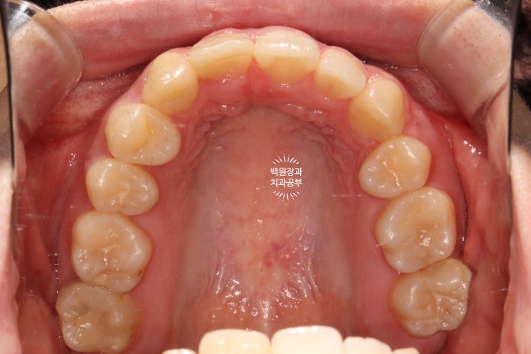 잇몸 성형과 치아미백 그리고 지르코니아 20대 앞니 크라운 치료. 치료과정/기간/비용. 관련 이미지 6