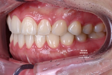 레브네이트 베이직. 치아미백과 치아교정을 한번에! 치아삭제 사진 있음. 신사역 치과 앞니라미네이트 모델/비용/후기. 관련 이미지 5