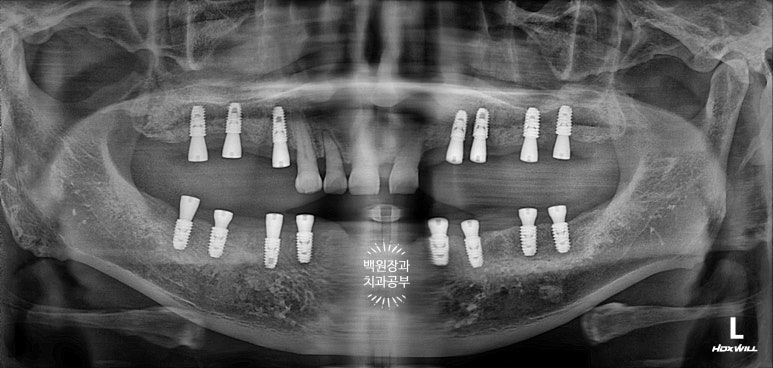 임플란트장인의 마음으로 8개월간 전체임플란트 완성. 치주과 전문의. 관련 이미지 19