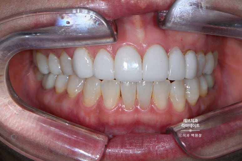 신사역 퍼스널컬러 맞춤 치과. 전담 세라미스트가 앞니 크라운과 라미네이트를 만들어 드립니다. 관련 이미지 14