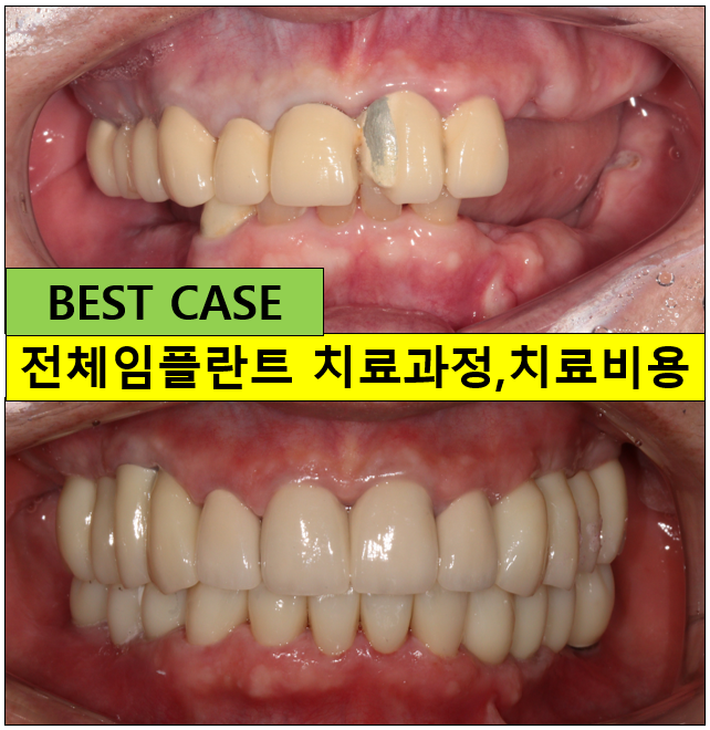 어금니 여러개가 없어요. 전체 임플란트와 앞니 크라운을 통한 완벽한 재건!! 치료과정/치료기간/비용/후기. 관련 이미지 1
