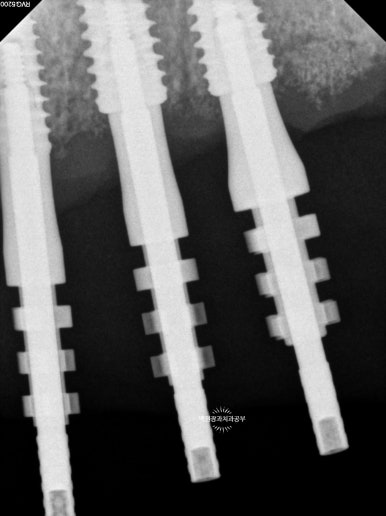 오스템임플란트 네비게이션 전체 임플란트 치료일기. 치료과정/치료기간/비용/솔직후기. 관련 이미지 13