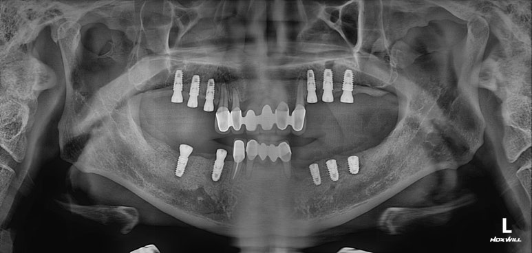 잇몸 염증 고름이 심했던 부위 - 만성치주염 진단하고 임플란트로 깔끔하게 치료! 신사역 치과 관련 이미지 22