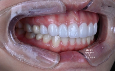 신사역 퍼스널컬러 맞춤 치과. 전담 세라미스트가 앞니 크라운과 라미네이트를 만들어 드립니다. 관련 이미지 13