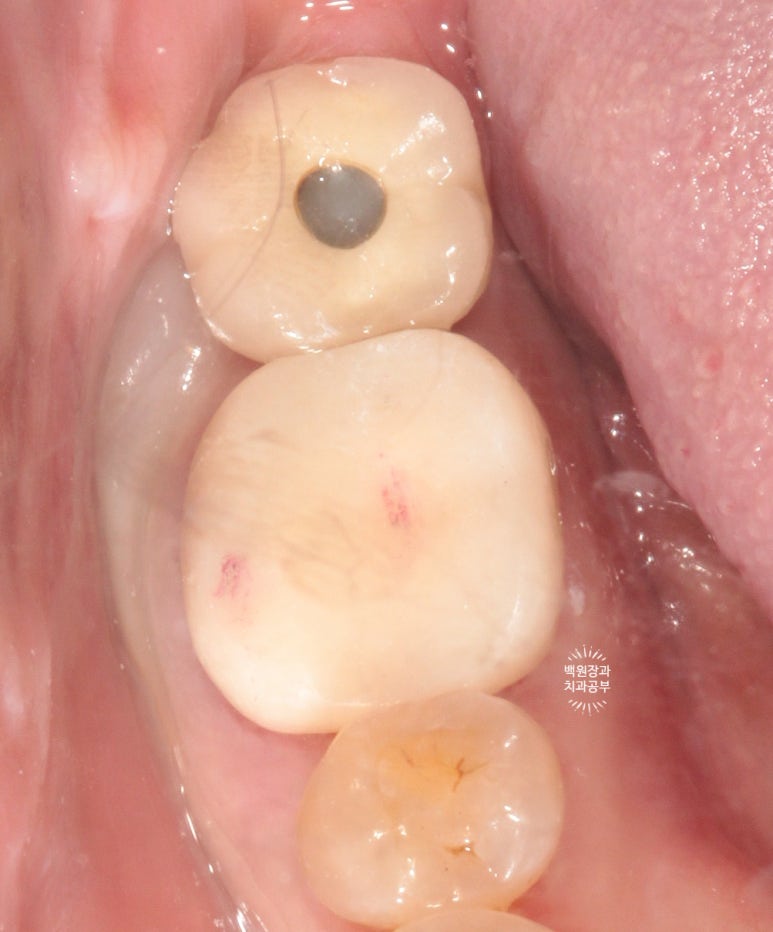 어금니 보철물이 떨어졌어요. 골드인레이 탈락 후 지르코니아 크라운으로 치료. 충치치료과정/치료기간/비용/후기. 관련 이미지 12
