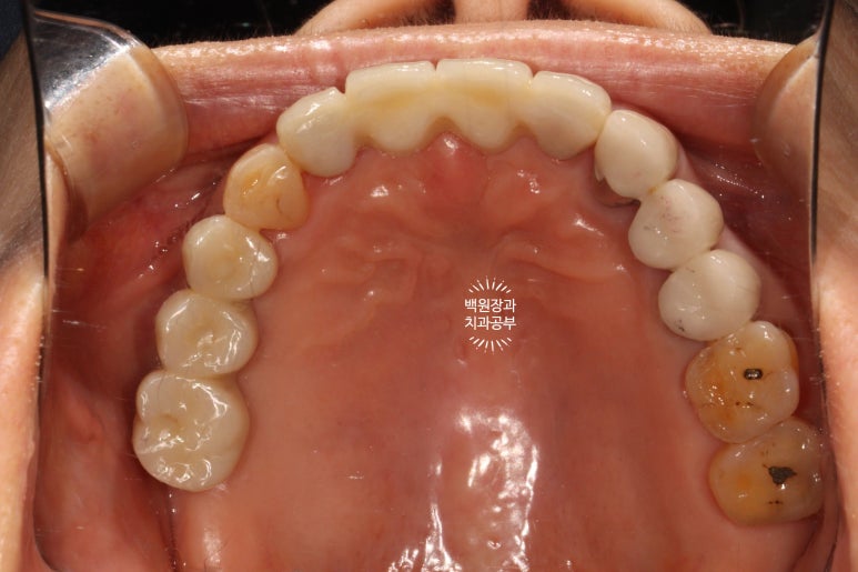 60대 임플란트 주변에서 고름이 나와요. 실패한 임플란트 제거 후 재수술. 덴티움 뼈이식재를 사용한 치조골 이식술. 관련 이미지 22