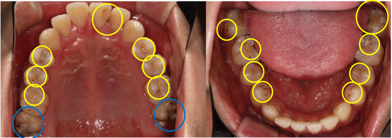 치과의 과잉진료에 대하여. 나는 양심 치과의사인가? 관련 이미지 5