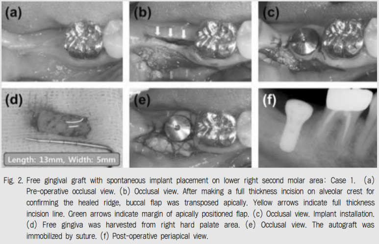 어금니 임플란트 주변 잇몸이식수술 - 저는 해야한다고 생각합니다. (feat. 대한치과의사협회 논문 + 치주과전문) 관련 이미지 5
