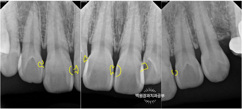 앞니레진치료 할 줄 모르는 치과의사는 없지만, 좋은 레진으로 치료하는 치과의사는 잘 없습니다. 관련 이미지 20