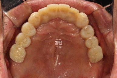 불편한 틀니를 아직도 쓰시나요? 전체 임플란트 치료비용/치료기간/치료과정. 관련 이미지 20