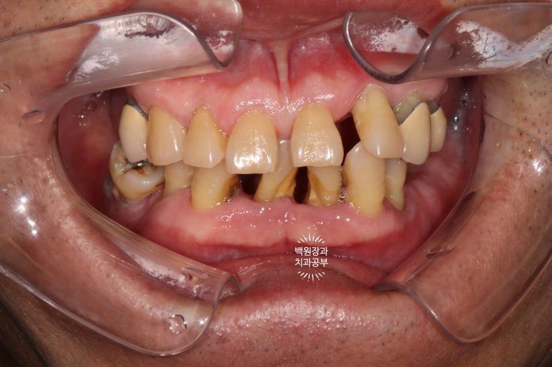 임플란트장인의 마음으로 8개월간 전체임플란트 완성. 치주과 전문의. 관련 이미지 28