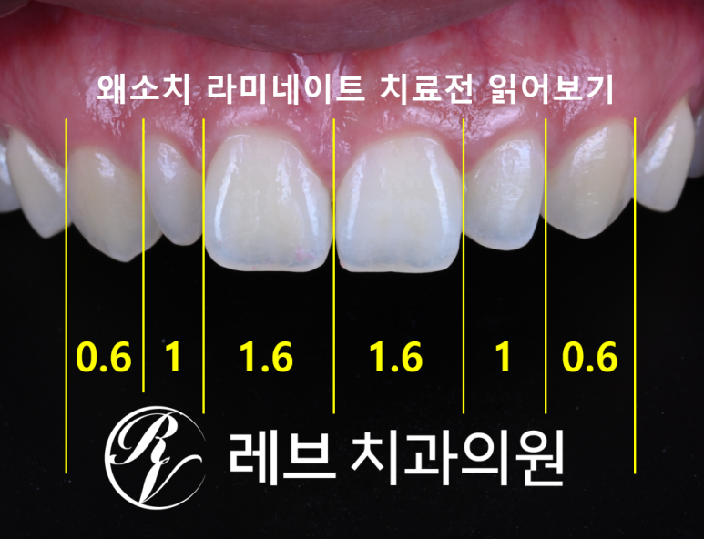 왜소치 라미네이트. 열심히 교정치료 받은 나를 위한 선물. 비용/과정/후기. 관련 이미지 1