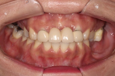 전세계 1위 스트라우만 임플란트를 사용한 어금니 기능회복과 앞니 지르코니아 크라운 증례. 관련 이미지 20