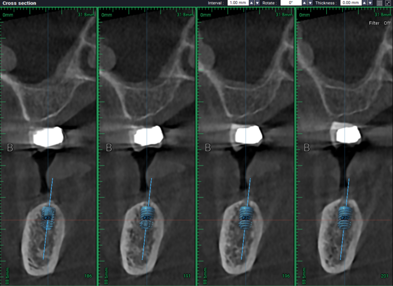 어금니 임플란트 주변 잇몸이식수술 - 저는 해야한다고 생각합니다. (feat. 대한치과의사협회 논문 + 치주과전문) 관련 이미지 15