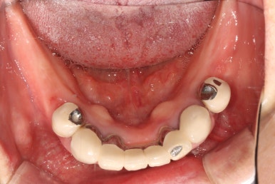 부분틀니를 오래써서 어금니가 아플 때, 아래턱 양쪽 어금니 임플란트 잘하는 강남임플란트치과 관련 이미지 8