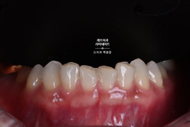아래앞니 라미네이트도 무삭제로 가능한가요? 레브네이트 베이직 가격/비용/후기/추천. 관련 이미지 14