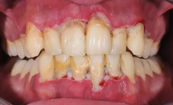잇몸치료에 대한 모든 것. 치주과 전문의가 설명하는 치주염 치료 비용,과정, 통증, 방법 그리고 치과 실비보험. 관련 이미지 12
