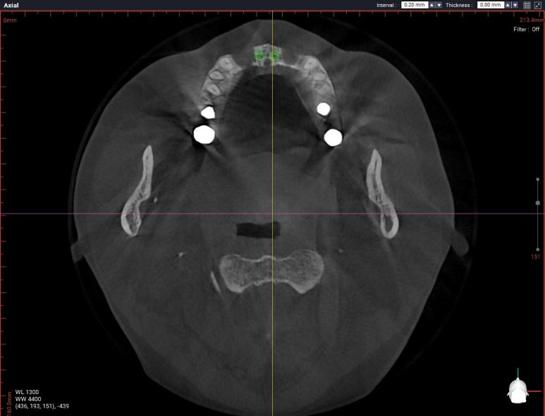 앞니가 풍치로 흔들거려요. 심한 치주염인데 임플란트 가능할까요? 치료과정/치료기간/비용/성공후기. 신금호역 치과 추천. 관련 이미지 15