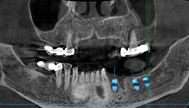어금니 임플란트 주변 잇몸이식수술 - 저는 해야한다고 생각합니다. (feat. 대한치과의사협회 논문 + 치주과전문) 관련 이미지 12
