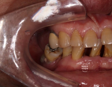 임플란트장인의 마음으로 8개월간 전체임플란트 완성. 치주과 전문의. 관련 이미지 4