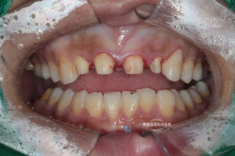 앞니에 잇몸염증과 충치가 심해요. 앞니 지르코니아 크라운 성공 후기. 치료과정/치료기간/비용/전후비교. 관련 이미지 15