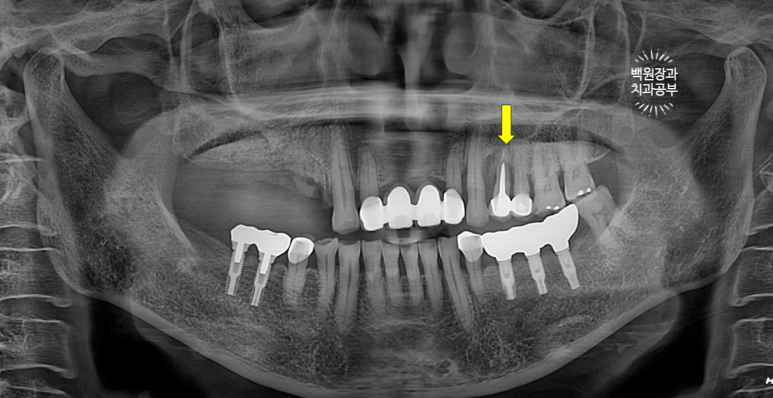 60대 임플란트 주변에서 고름이 나와요. 실패한 임플란트 제거 후 재수술. 덴티움 뼈이식재를 사용한 치조골 이식술. 관련 이미지 11