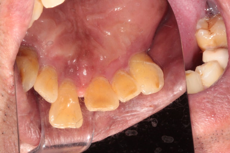 큰 어금니를 잃을 정도의 풍치를 앓으셨다면, 조속한 어금니 임플란트는 필수입니다. 관련 이미지 8