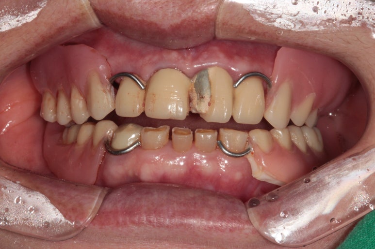 어금니 여러개가 없어요. 전체 임플란트와 앞니 크라운을 통한 완벽한 재건!! 치료과정/치료기간/비용/후기. 관련 이미지 8