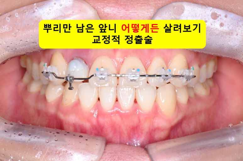 서울 신사역 [레브치과] 뿌리만 남은 앞니의 마지막 치료법. 교정적 정출술 (부분교정) + 크라운. 관련 이미지 1
