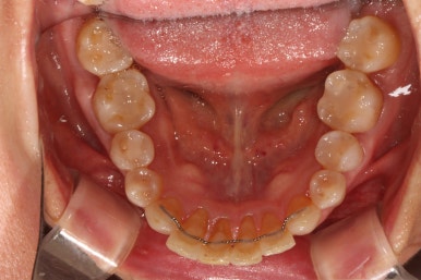 삐뚤어진 앞니를 8개월만에 가지런하게 만드는 50대 성인부분교정. 신사역 교정치과. 치료과정/기간/비용. 관련 이미지 29