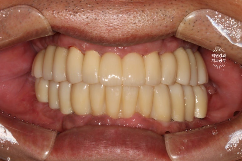 만성치주염으로 인해 아주 좁아진 잇몸뼈에 광범위한 뼈이식 + 전체임플란트. 신사 레브치과. 관련 이미지 53