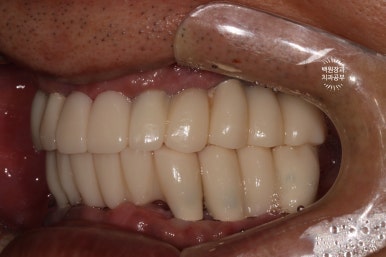 만성치주염으로 인해 아주 좁아진 잇몸뼈에 광범위한 뼈이식 + 전체임플란트. 신사 레브치과. 관련 이미지 51