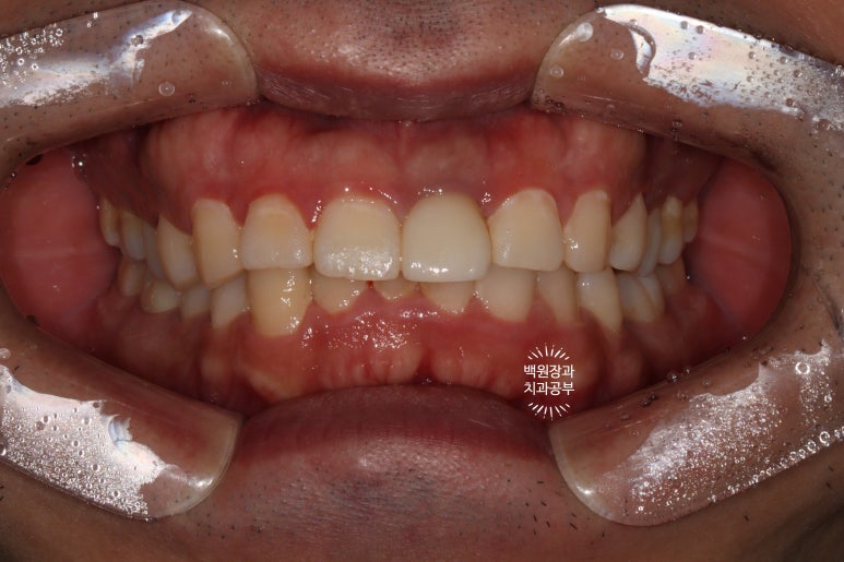 앞니 머리가 기둥째 부러졌어요. 발치 동시 뼈이식 오스템 BA 임플란트. 치료과정/치료기간/비용/후기. 압구정 치과. 관련 이미지 23