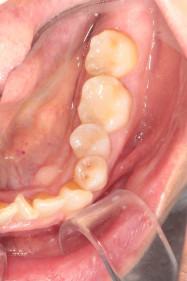 삐뚤어진 앞니를 8개월만에 가지런하게 만드는 50대 성인부분교정. 신사역 교정치과. 치료과정/기간/비용. 관련 이미지 7