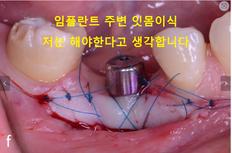 어금니 임플란트 주변 잇몸이식수술 - 저는 해야한다고 생각합니다. (feat. 대한치과의사협회 논문 + 치주과전문) 관련 이미지 1