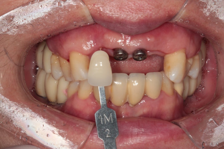 앞니가 풍치로 흔들거려요. 심한 치주염인데 임플란트 가능할까요? 치료과정/치료기간/비용/성공후기. 신금호역 치과 추천. 관련 이미지 27