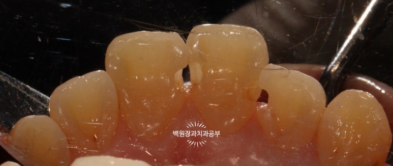 앞니레진치료 할 줄 모르는 치과의사는 없지만, 좋은 레진으로 치료하는 치과의사는 잘 없습니다. 관련 이미지 24