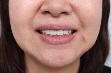 레브네이트 엑스퍼트 - 앞니 무삭제 라미네이트. 40대 벌어진 앞니에 변색된 레진은 이제 그만! 압구정 치과 추천 전후/비용. 관련 이미지 15