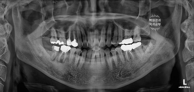 신경치료한 치아 부러짐! 뼈이식 하면서 임플란트 수술하는 과정/기간/비용. 관련 이미지 2