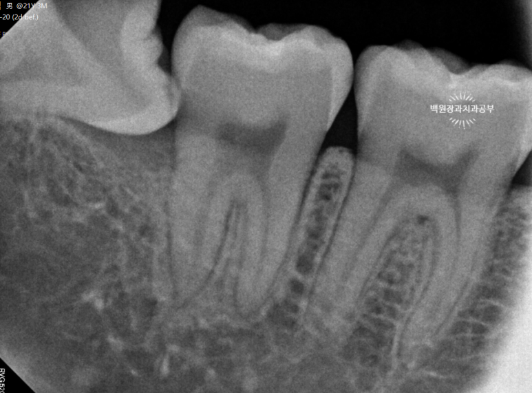 매복 사랑니 10분만에 뽑기! 치료과정/치료기간/비용/후기. 관련 이미지 4