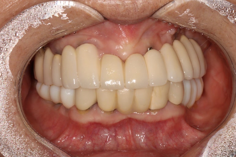 부분틀니를 오래써서 어금니가 아플 때, 아래턱 양쪽 어금니 임플란트 잘하는 강남임플란트치과 관련 이미지 18