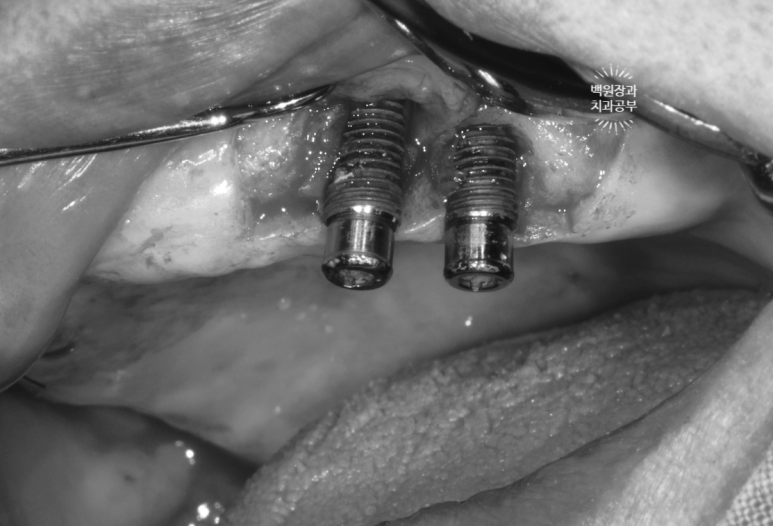 임플란트에서 고름이 나와요. 임플란트 주위염 그리고 재수술을 위한 준비. 치료과정/치료기간/비용/후기. 관련 이미지 8