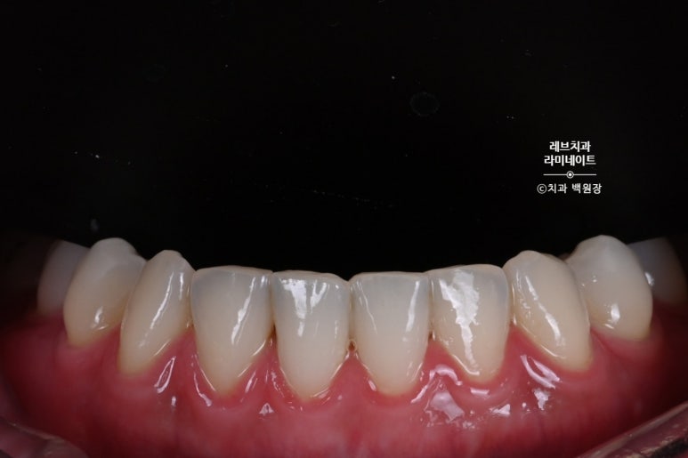 레브네이트 베이직. 치아미백과 치아교정을 한번에! 치아삭제 사진 있음. 신사역 치과 앞니라미네이트 모델/비용/후기. 관련 이미지 7