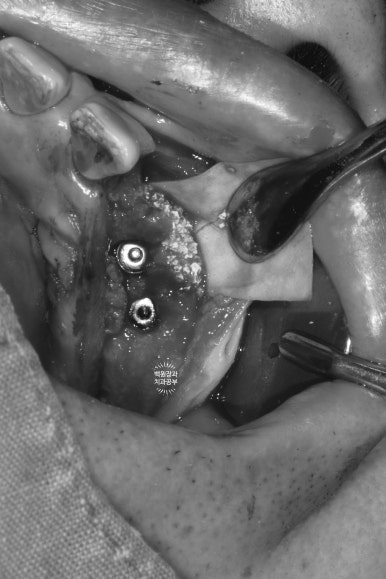 임플란트장인의 마음으로 8개월간 전체임플란트 완성. 치주과 전문의. 관련 이미지 13