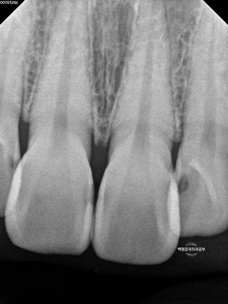 앞니레진치료 할 줄 모르는 치과의사는 없지만, 좋은 레진으로 치료하는 치과의사는 잘 없습니다. 관련 이미지 18